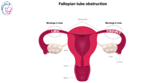 फैलोपियन ट्यूब ब्लॉक होने पर प्रेगनेंसी कैसे संभव है? Natural vs IVF Guide